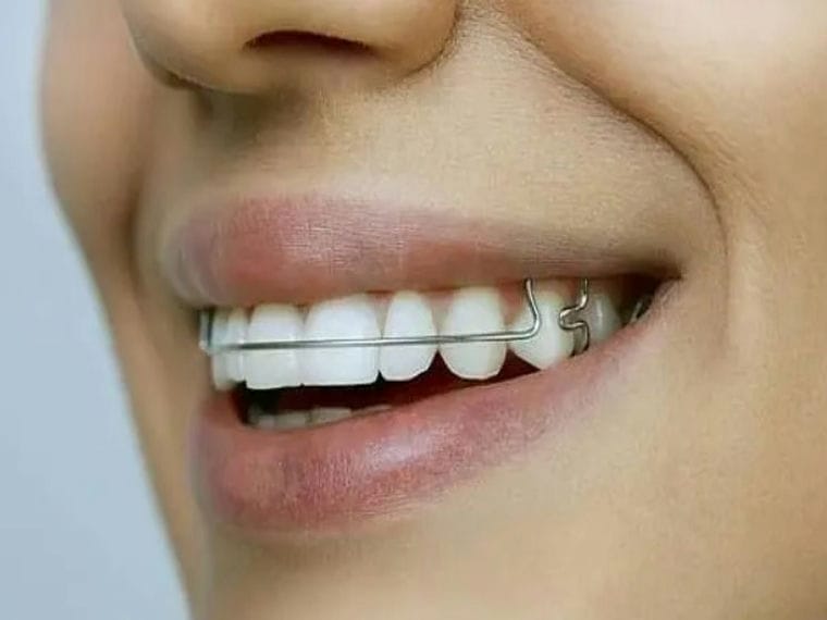 Stainless Steel Flat Wire for Medical Orthodontic Uses